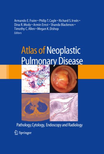 Atlas of Neoplastic Pulmonary Disease: Pathology, Cytology, Endoscopy and Radiology (English Edition)