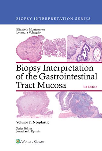 Biopsy Interpretation of the Gastrointestinal Tract Mucosa: Volume 2: Neoplastic (Biopsy Interpretation Series) (English Edition)