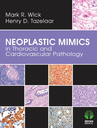 Neoplastic Mimics in Thoracic and Cardiovascular Pathology (Pathology of Neoplastic Mimics) (English Edition)