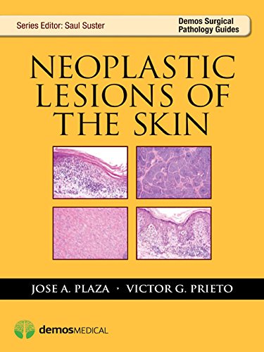 Neoplastic Lesions of the Skin (Demos Surgical Pathology Guides) (English Edition)